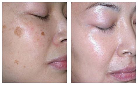 Skin Pigmentation Treatment And Removal Melbourne Dermacare Cosmetic
