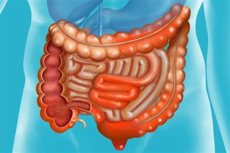 Clinical Remission Endoscopic Response Seen With Upadacitinib In Crohn Disease Trial