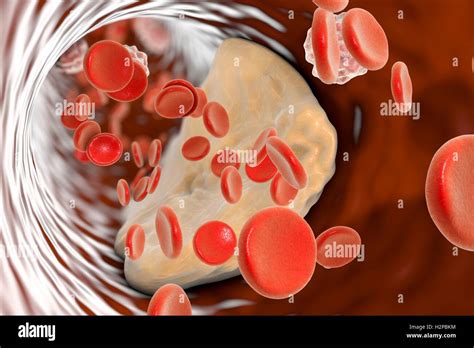 Atheromatous Plaque Inside Blood Vessel Hi Res Stock Photography And