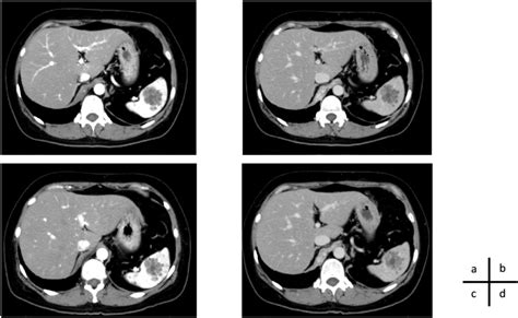 Contrast Enhanced Computed Tomography Ct Scans Obtained In Case 2