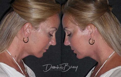 Lisa 54 45 54 Face And Necklift Liposculpture Neck Dr Dominic Bray