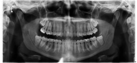 Wisdom Teeth Extraction Oral Surgery Flawless Dental