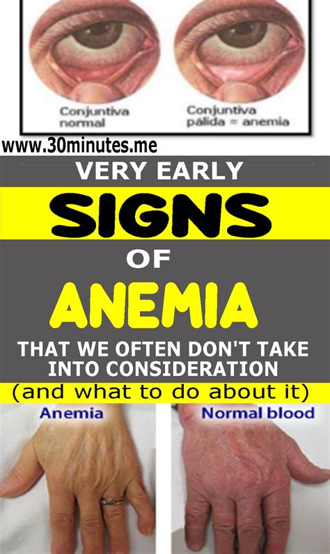 7 Signs Of Anemia That You May Not Be Aware Of And How To Treat It