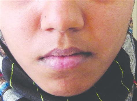 21 Year Old Female Patient With Swelling On The Right Side Of The Face
