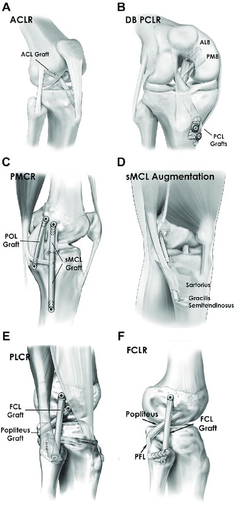 Reconstruction Techniques Used For Multiligament Knee Reconstruction