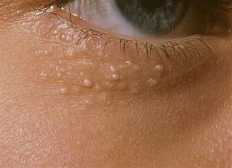 White Bump On The Eyelid Causes And Treatment