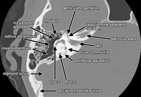 Interactive Web Based Learning Module On Ct Of The Temporal Bone