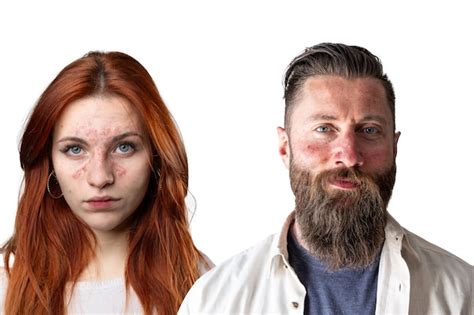 Premium Photo Man And Woman Suffering From Rosacea On Face Skin