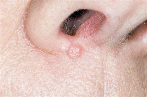Basal Cell Carcinoma Below The Nostril Stock Image C0033030