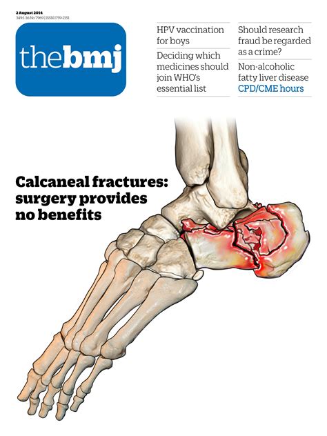 Calcaneal Fractures The Bmj