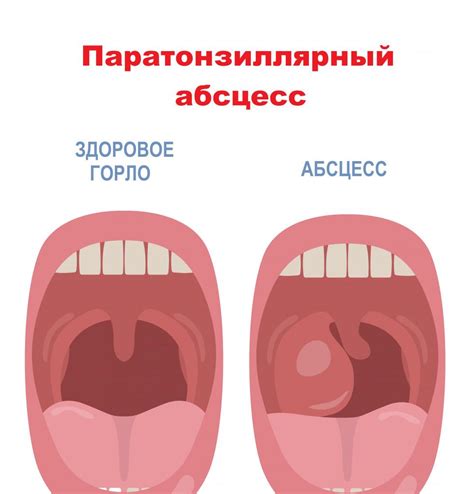 Лечение тонзиллита в Москве лазером цена от 2500 руб