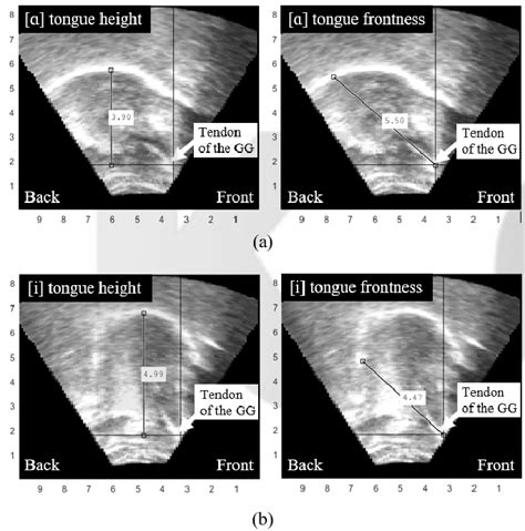 Example Midsagittal Ultrasound Images Of The Low Back Vowel ɑ A And