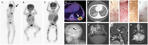 Eosinophilic Granuloma Causes Symptoms Diagnosis Treatment And Prognosis