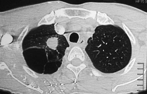 CT Thorax Lung Window Showing Spiculated Pulmonary Nodule At The