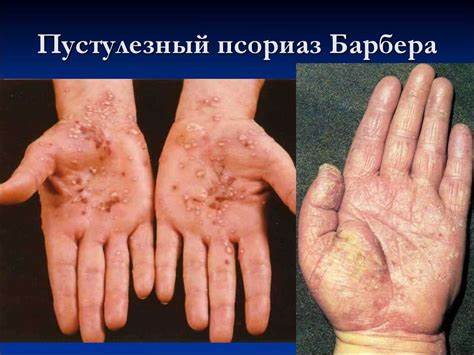 Псориаз диета по Пустулезный псориаз: симптомы (ФОТО) и лечение псориаза Барбера Пустулезный псориаз: симптомы (ФОТО) и лечение псориаза Барбера Псориаз диета по