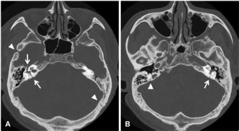 Two Slices Of Preoperative Temporal Bone Ct Axial Scan Open I