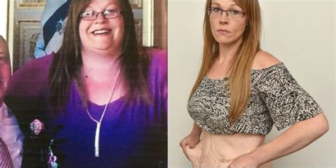 Woman Says Her Excess Skin From Weight Loss Is Worse Than Being Obese