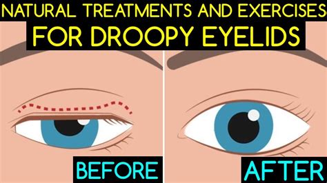 Natural Treatments And Exercises For Droopy Eyelids Youtube