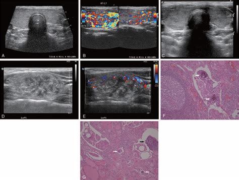The Diffuse Sclerosing Variant Of Papillary Thyroid Cancer P Medicine