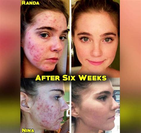 youtube stars who battled acne say they cleared skin through a low fat diet abc news