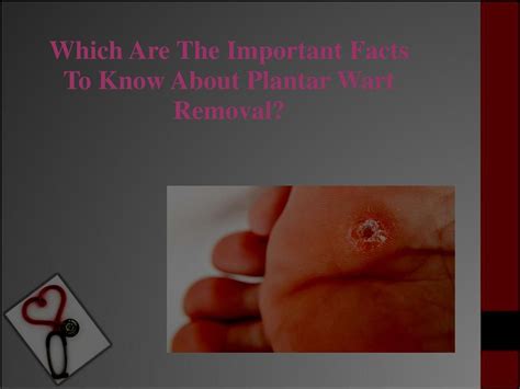 Ppt Which Are The Important Facts To Know About Plantar Wart Removal Powerpoint Presentation