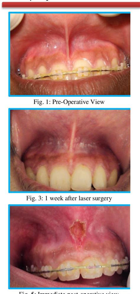 Figure From Maxillary Labial Frenectomy Using Diode Laser Report Of Two Cases Semantic Scholar