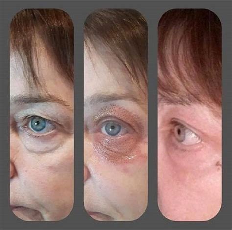 Look At These Amazing Results From Our Fibroblast Plasma