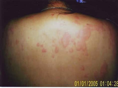 Dermatitis atopik atau eksim muncul di leher, tubuh. Bercak Merah Pada Kulit - Catatan Sugasetya
