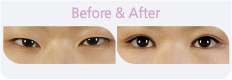 Bk Plastic Surgery Eyelid Surgery Lateral Hotzlowering The Outer Corner And Outer Corner