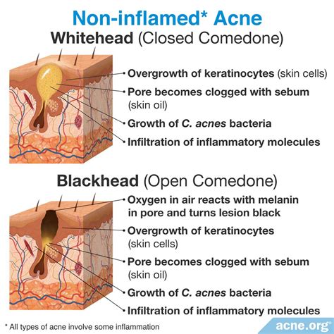 What Is The Difference Between Inflamed And Non Inflamed Acne