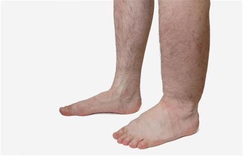 Edema Types Causes Symptoms And Treatment