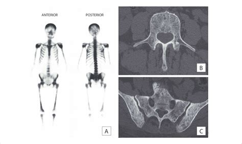 A 99m Tc Bone Scintigraphy Showing Diffusely Increased Skeletal