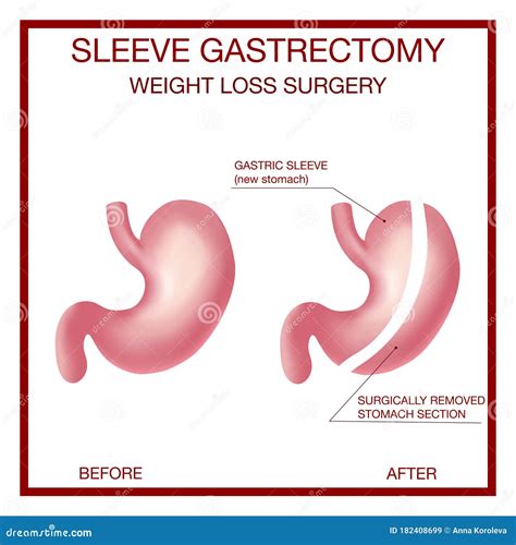 vertical sleeve gastrectomy weight loss surgery anatomical stock vector illustration of