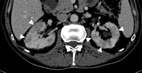 Atypical Mycobacterial Infection 69 Year Old Man With A Previous