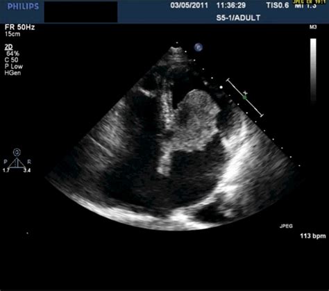 Large Left Atrial Myxoma With An Unusual Origin Bmj Case Reports