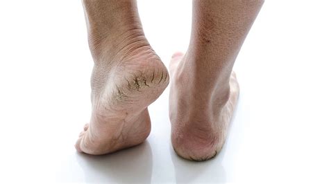 Bioped Cold Weather Leading To Dry Cracked Feet