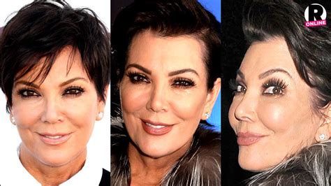 Plastic Fantastic Surgeon Claims Kris Jenner Used Botox Injections