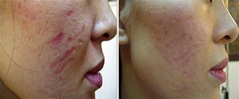 Before And After Images For Dermapen Microneedling