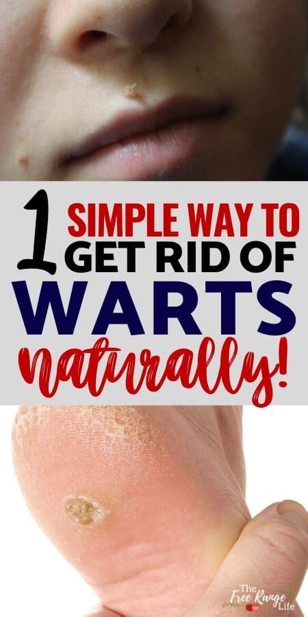 The Easiest Way To Get Rid Of Warts Naturally