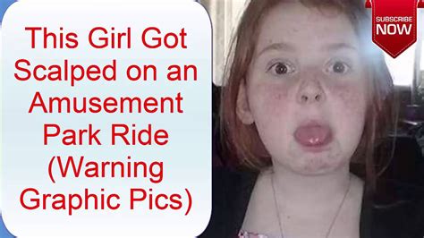 This Girl Got Scalped On An Amusement Park Ride Warning Graphic Pics