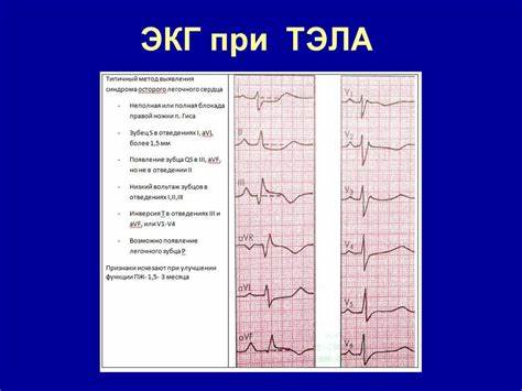 Тромбоэмболия легочной артерии - презентация онлайн Картинка - Тромбоэмболия легочной артерии - презентация онлайн
