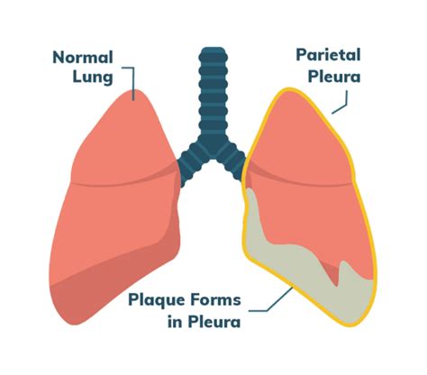 Malignant Mesothelioma Cancer Stages Prognosis Treatment