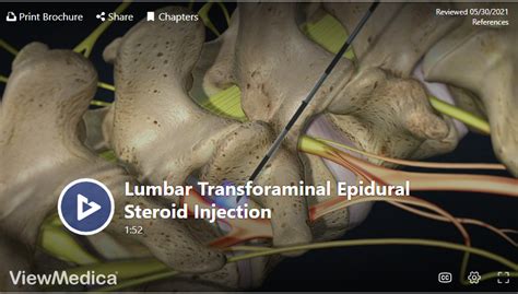 Lumbar Epidural Steroid Injection In Knoxville Omega Pain Doctor