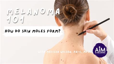 How Do Skin Moles Form Youtube