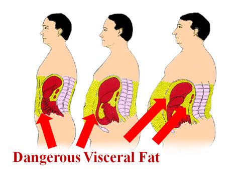 10 Horrible Diseases Caused By Carrying Too Much Visceral Belly Fat