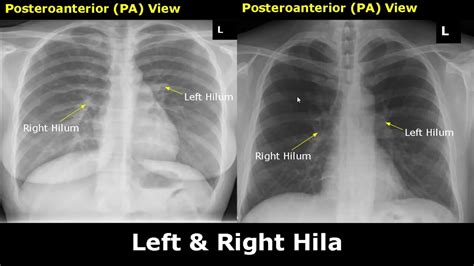 Normal Chest X Ray Labelled Anatomy Pa View Cxr Interpretation Ribs
