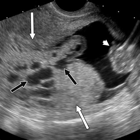 Gestational Trophoblastic Disease Clinical And Imaging Features