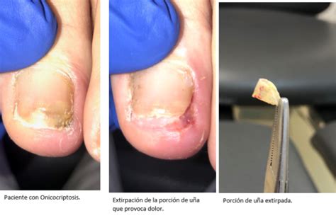 Qué Es La Uña Encarnada Onicocriptosis Y Cómo Tratarla Clínica Fivasa