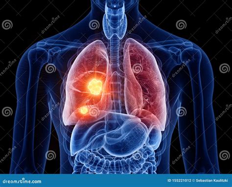 Lung Cancer Stock Illustration Illustration Of Accurate 155221012