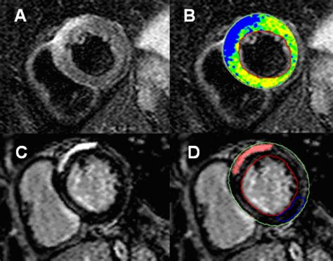 Cmr is ideally suited to answer that. Myocardial edema in a patient with active myocarditis. A ...